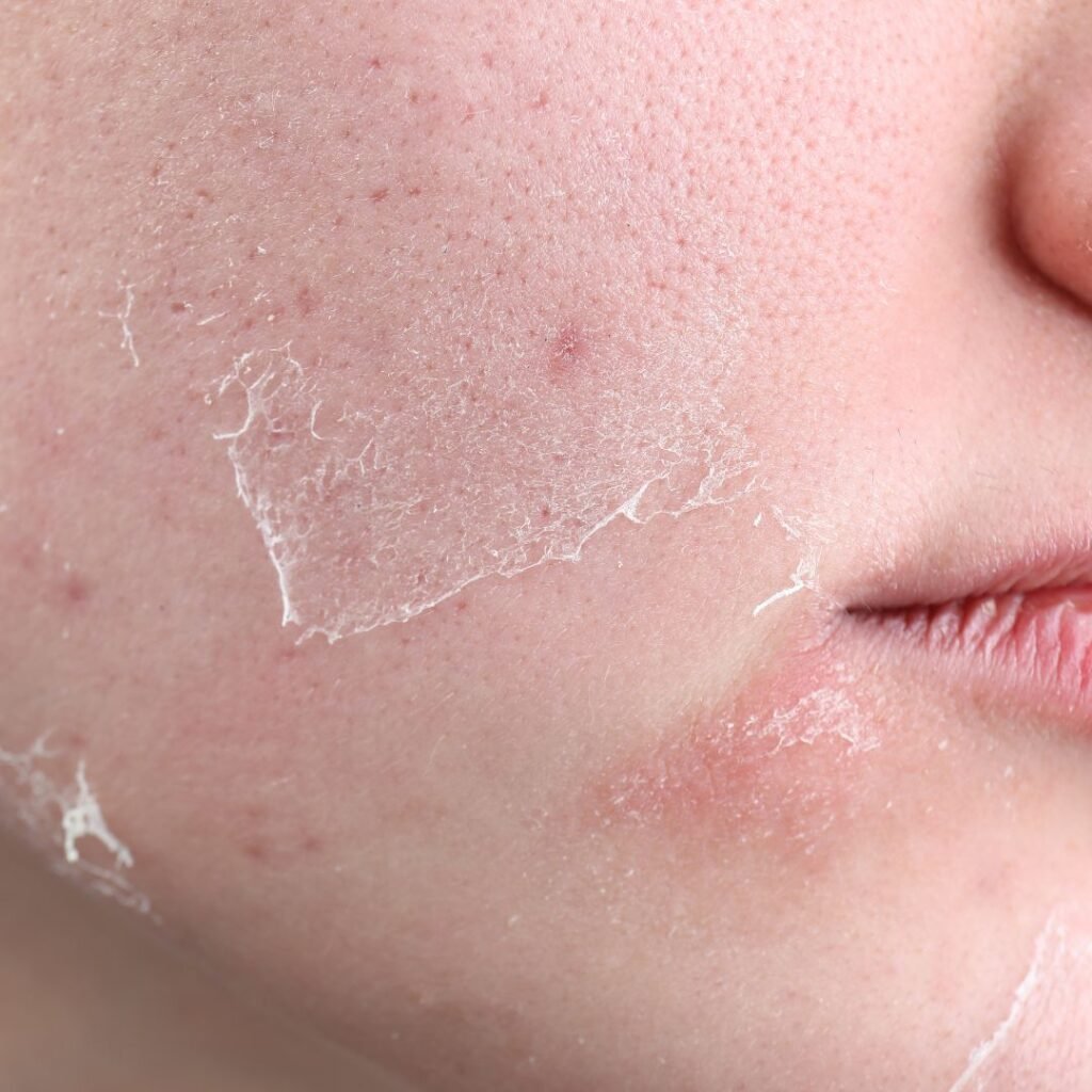 peeling skin signs of over exfoliated skin damage